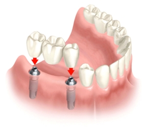 impianto per mancanza denti vicini