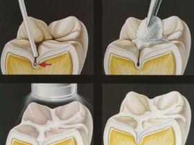 sigillatura molari per bambini